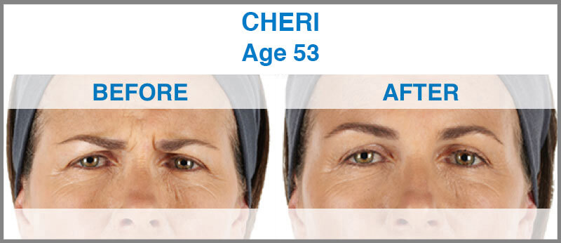 Before & After Photos & Reviews | XEOMIN® For Frown Lines