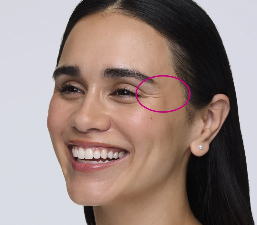 Woman smiling to show crow's feet with a pink circle around them