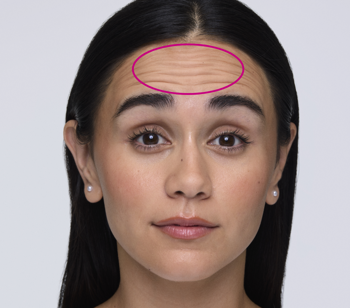 Woman patient Prsicilla scrunching her face showing lines on her forehead also known as 'worry lines'.