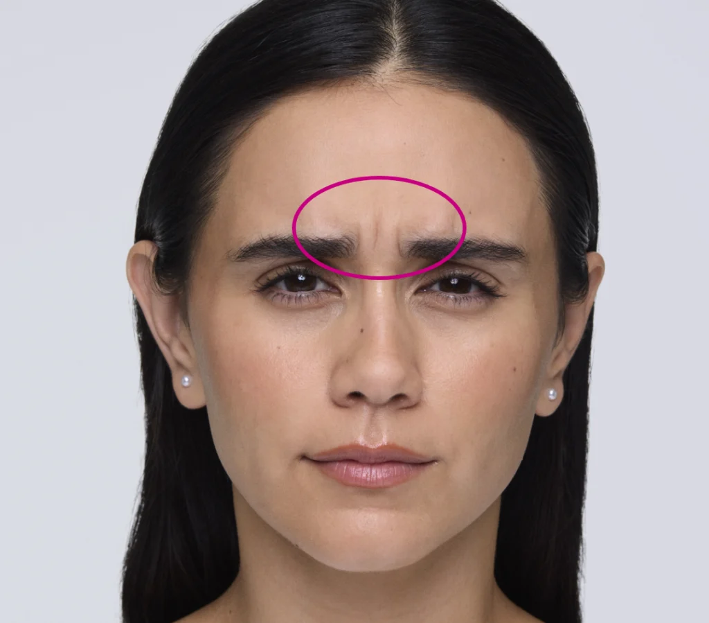 Woman scowling to show frown lines with a pink circle around them