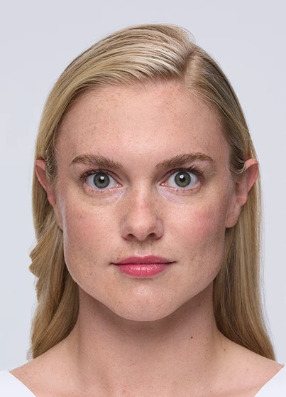 Patient Melinda raising her eyebrows with a smooth forehead.