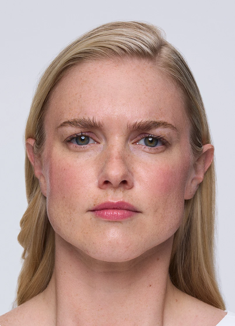 Patient Melinda frowning with no lines near her eyebrows.