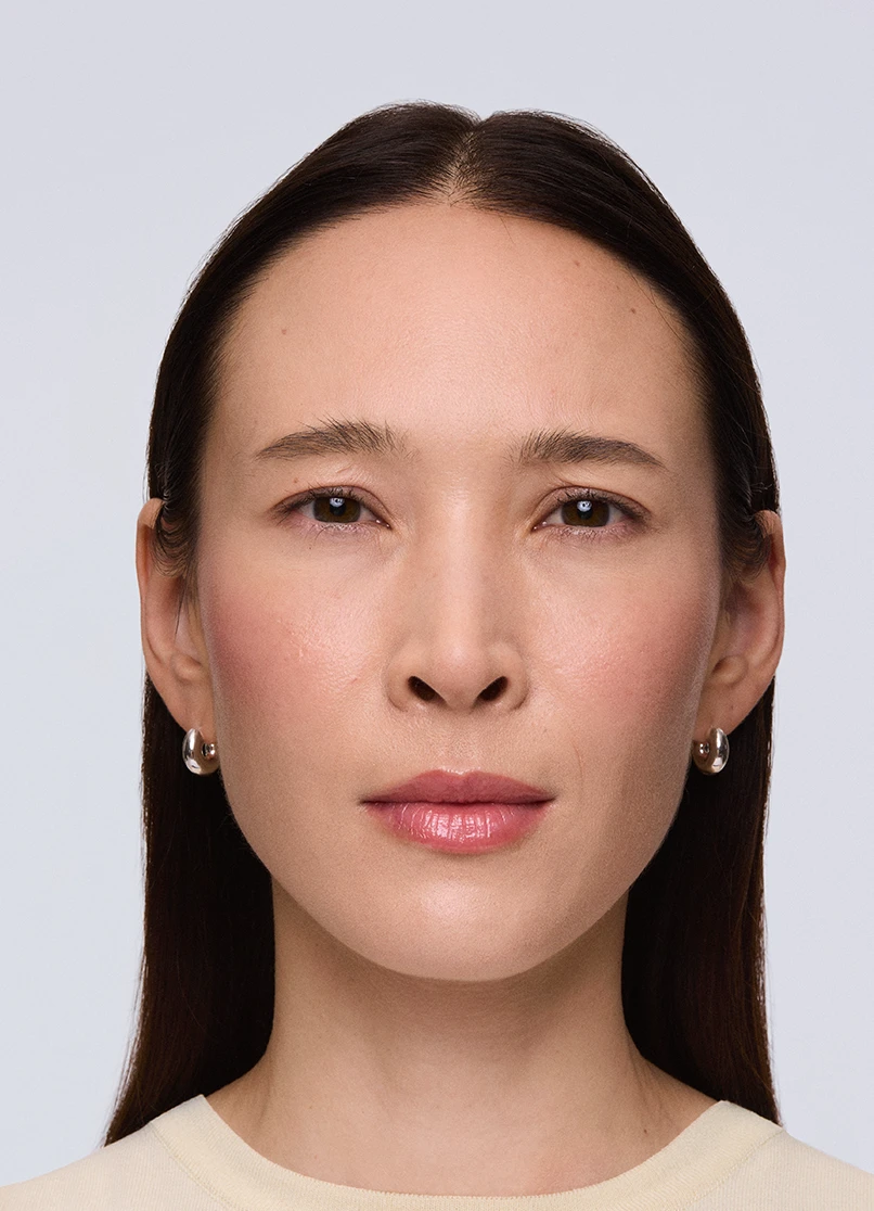 Patient Rebecca frowning with no lines near her eyebrows.