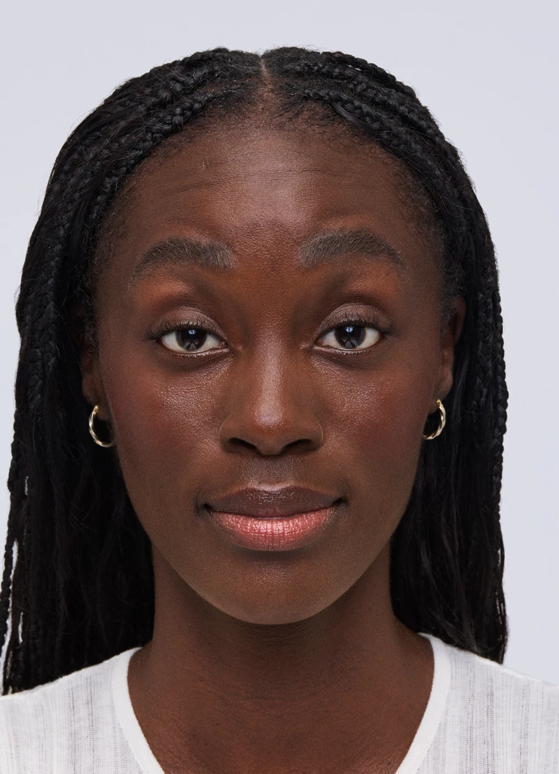 Patient Aleka raising her eyebrows with wrinkles on her forehead