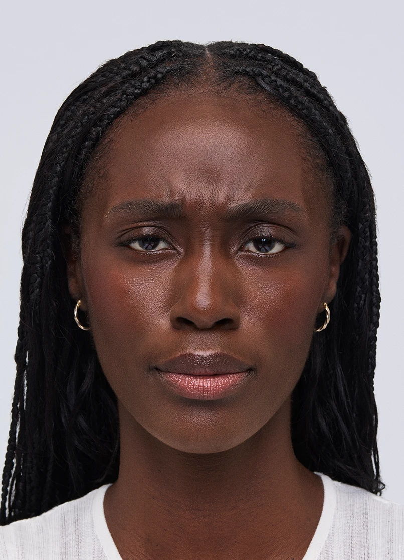 Patient Aleka frowning with lines near her eyebrows.