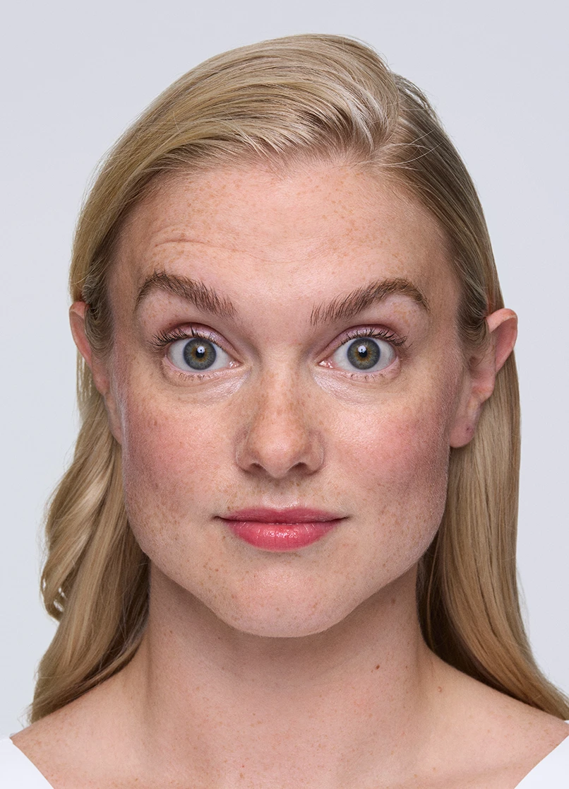 Patient Melinda raising her eyebrows with wrinkles on her forehead