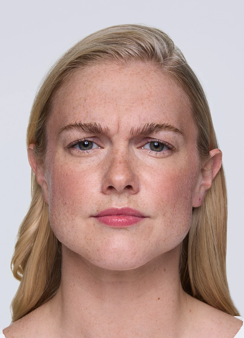 Patient Melinda frowning with lines near her eyebrows.