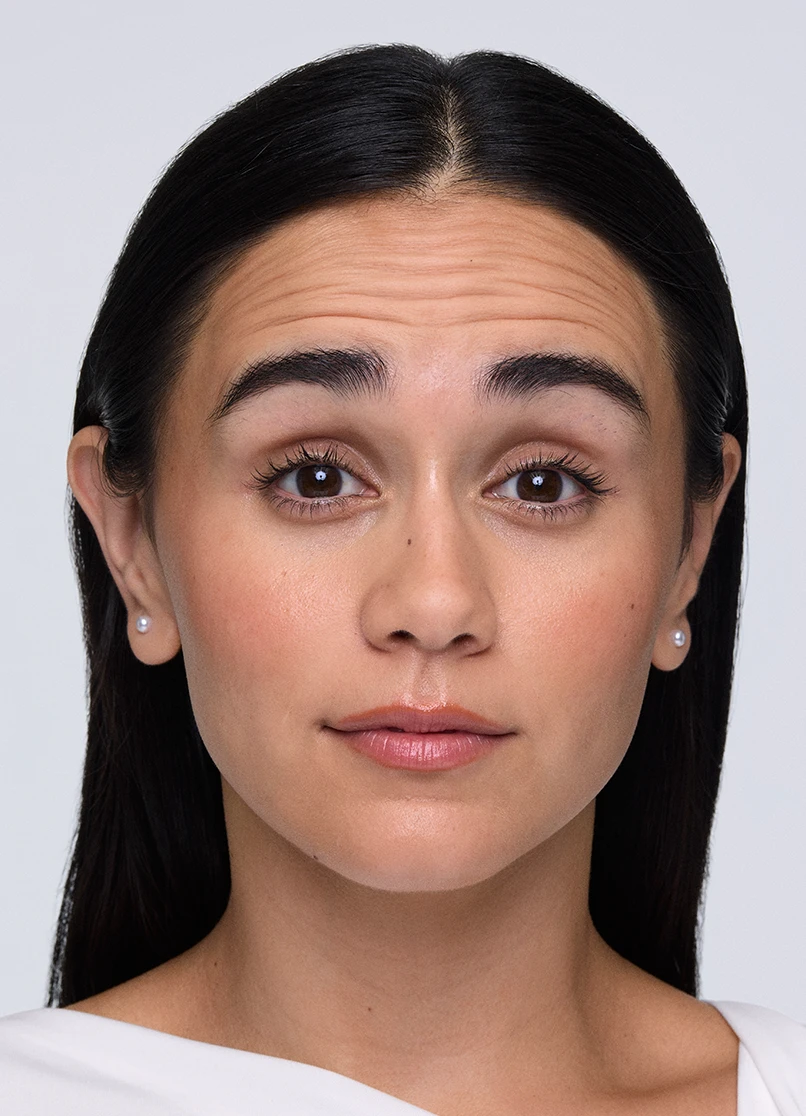 Patient Priscilla raising her eyebrows with wrinkles on her forehead
