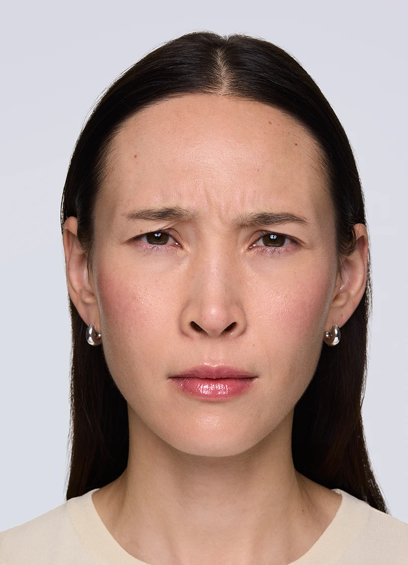 Patient Rebecca frowning with lines near her eyebrows.